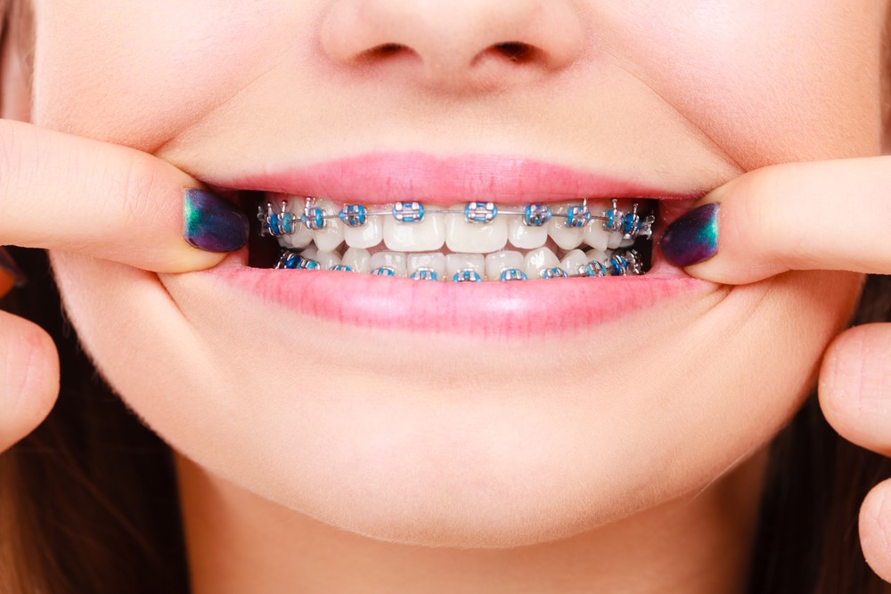 Braces And Missing Teeth | Orthodontic Associates