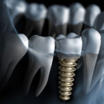 Dental Implants: Say Hello to Your New Permanent Teeth