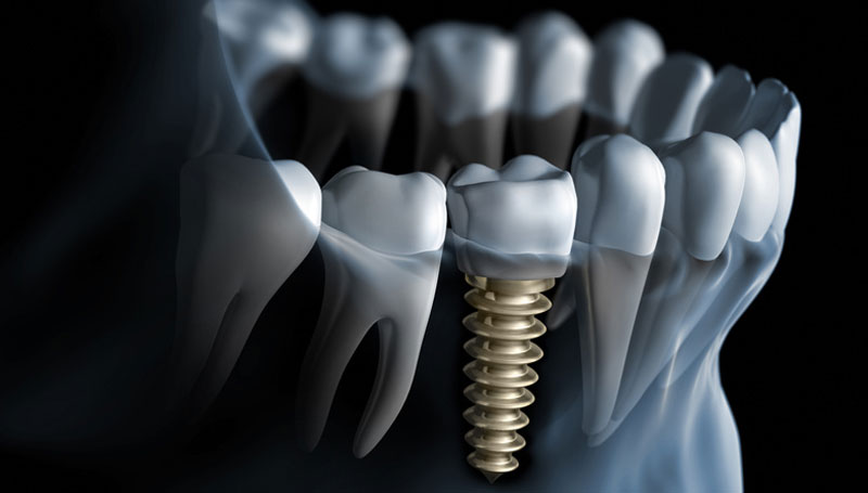 Dental Implants: Say Hello to Your New Permanent Teeth