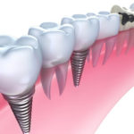 You Can Go for Dental Restoration and Smile Again