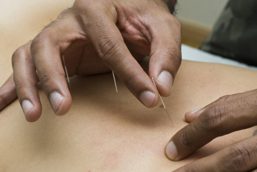 Health and Wellness- What to Expect from an Acupuncturist