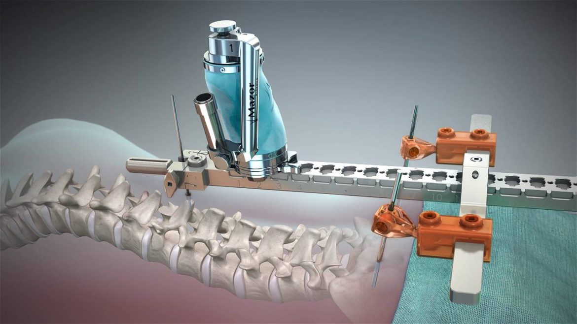 Traditional Spine Surgery Versus Robotic Spine Surgery – Details You Cannot Ignore!