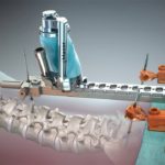 Traditional Spine Surgery Versus Robotic Spine Surgery – Details You Cannot Ignore!