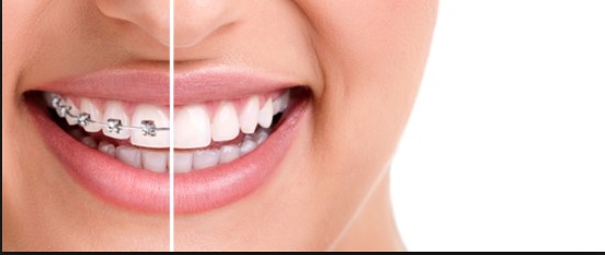 All You Need to Know About Braces