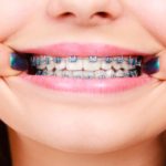 4 Conditions That May Require the Use of Dental Braces