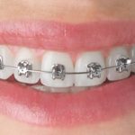 An easy introduction to orthodontic treatment
