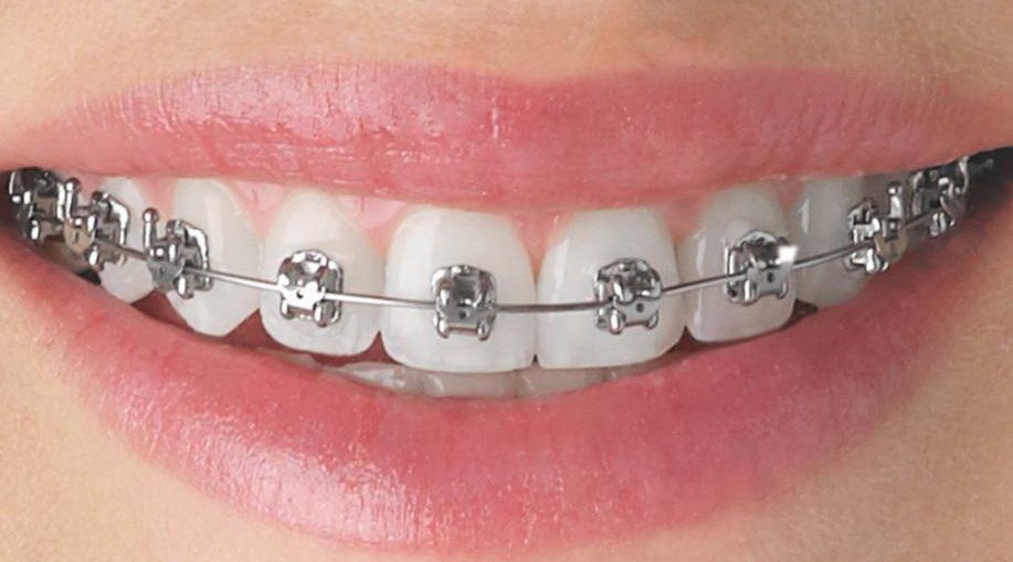 An easy introduction to orthodontic treatment WorthvieW