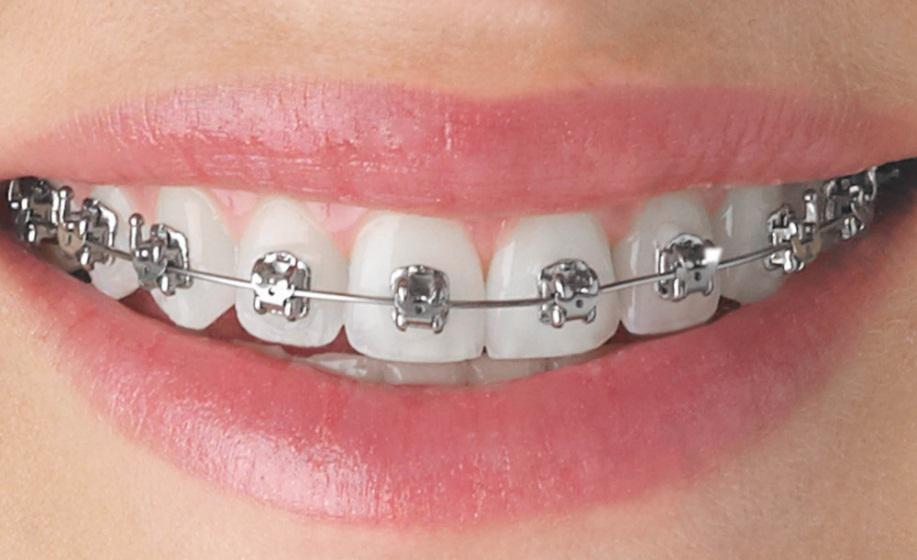 An easy introduction to orthodontic treatment