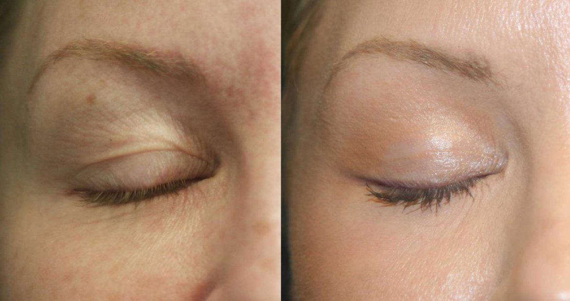 Skincare Regimen After Laser Skin Resurfacing