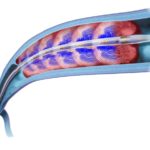 All You Need to Know About DVT Treatments