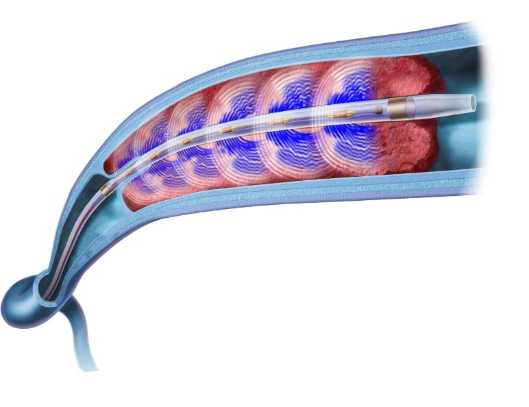 All You Need to Know About DVT Treatments