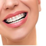 4 Common Teeth Straightening Problems and Their Solutions