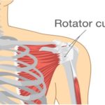 How To Avoid Re-Injury After Rotator Cuff Rehab