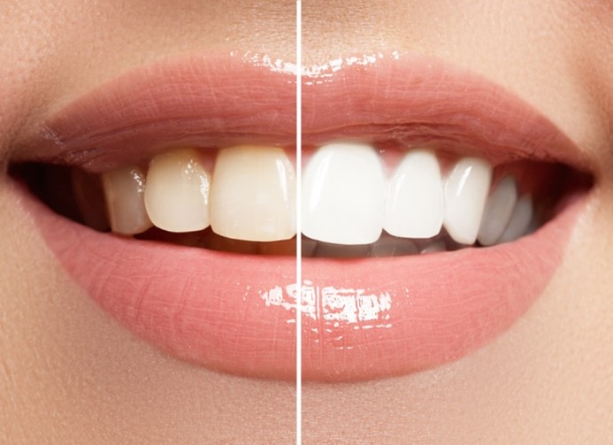 The Top 5 Myths About Teeth Whitening – Busted!