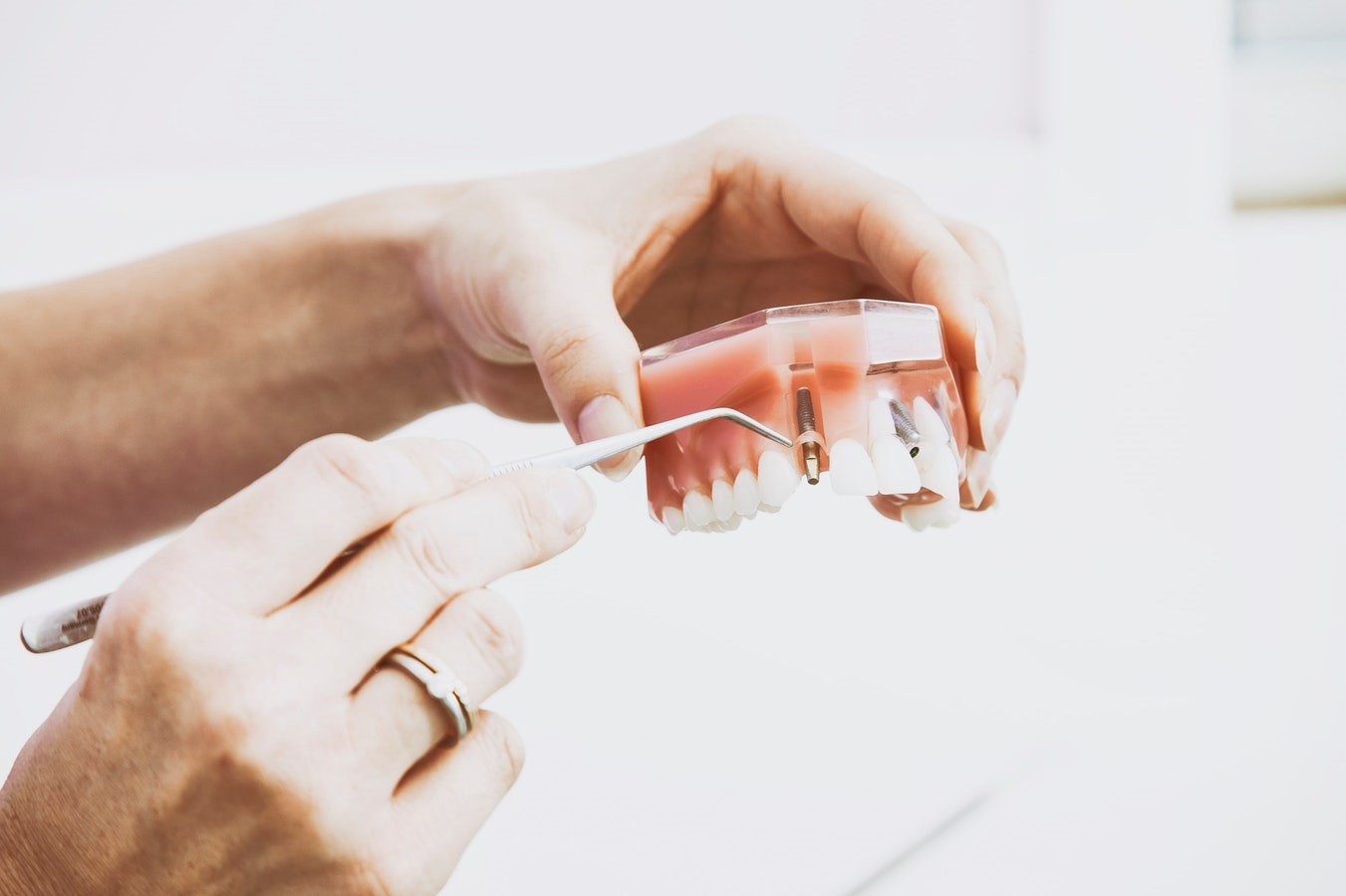 All-on-4 vs All-on-6 Dental Procedures And What You Should Know About Them