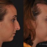 Fixing a Bulbous, Rounded Nose with Rhinoplasty