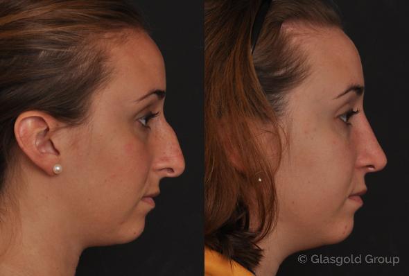 Fixing a Bulbous, Rounded Nose with Rhinoplasty