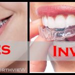 The Pros and Cons of Invisalign vs. Braces