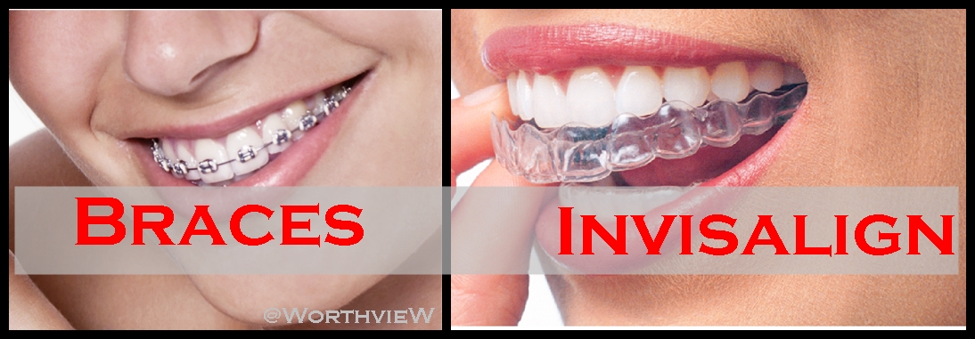 The Pros and Cons of Invisalign vs. Braces