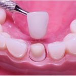 Should I get Dental Implants or Dental Crowns?