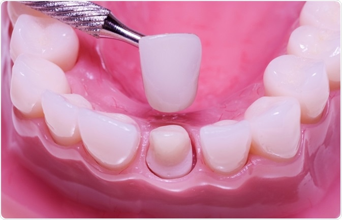 Should I get Dental Implants or Dental Crowns?