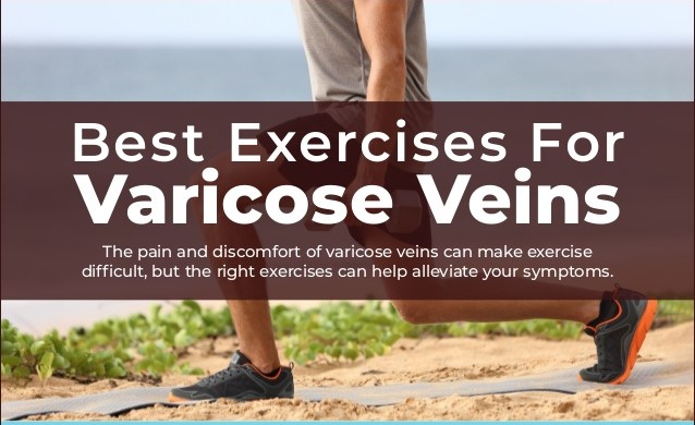 Varicose Vein Exercise Tips