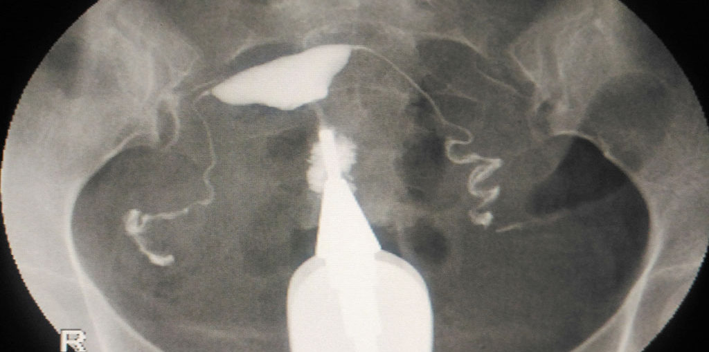 How to Prepare for an HSG Test WorthvieW