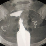 How to Prepare for an HSG Test