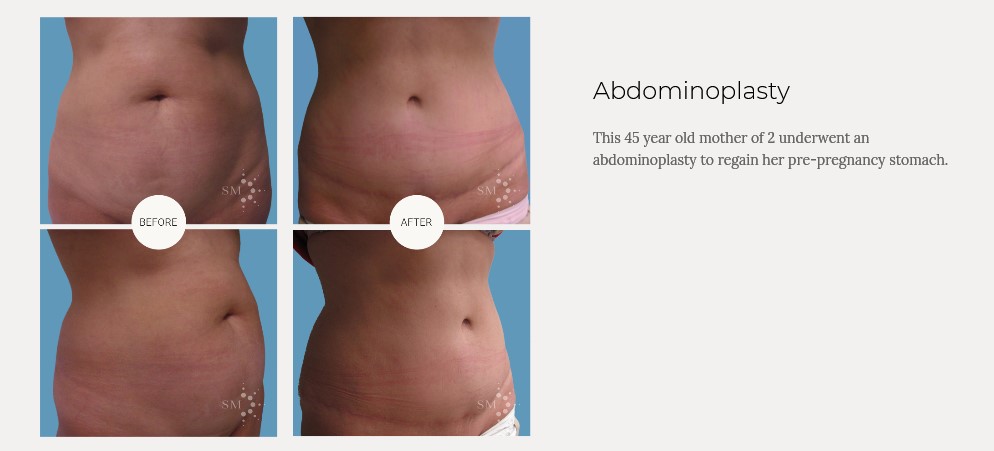 What is a Tummy Tuck?
