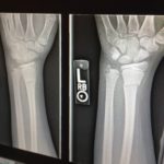 Various Types of Braces and How They Help With Rehabilitation and Prevention