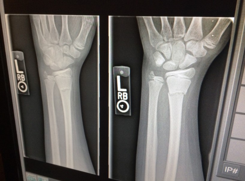 Various Types of Braces and How They Help With Rehabilitation and Prevention