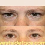 The Ultimate Guide To Eyelid Surgery Santa Monica