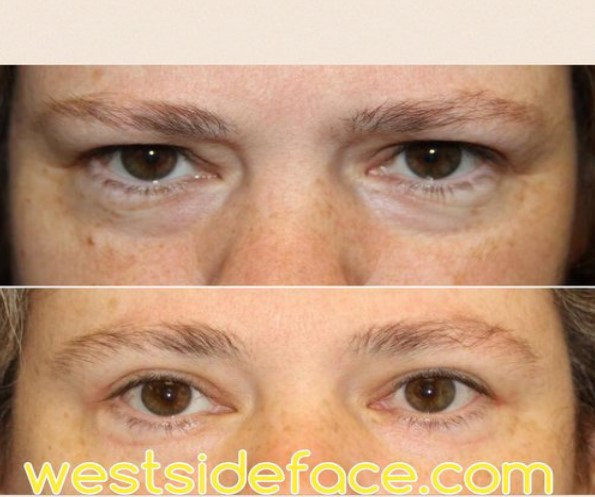 The Ultimate Guide To Eyelid Surgery Santa Monica
