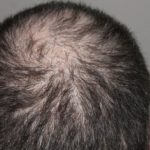 Prime HTC M.D. Resat Arpaci Can You Get Permanent Results From A Hair Transplant?