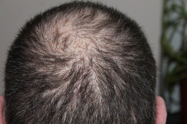 Prime HTC M.D. Resat Arpaci Can You Get Permanent Results From A Hair Transplant?