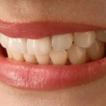 Which Veneers Are Better: Porcelain Veneers Sydney or Resin Veneers?