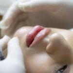Lip Fillers: Should You Opt or Should You not Opt for it
