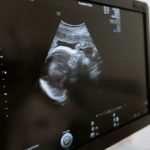 What You Need to Know About Sonograms