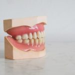 Dental Health: Things to Know About Dental Bridges