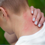 Why Do Mosquitoes Bite Itch?