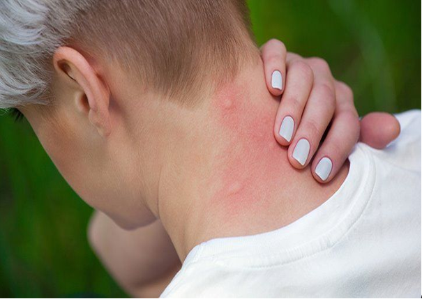 Why Do Mosquitoes Bite Itch?