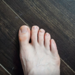 Toenail Fungus vs. Athlete’s Foot: What’s the Difference?