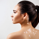 How to use UV lamps to treat vitiligo?