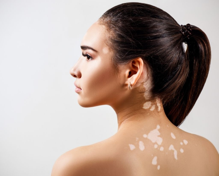 How to use UV lamps to treat vitiligo?