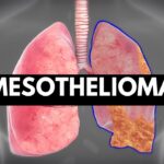 When Should You Get Tested for Mesothelioma?